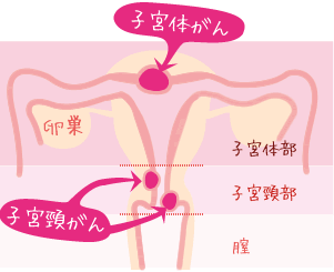 子宮体がん・子宮頸がん